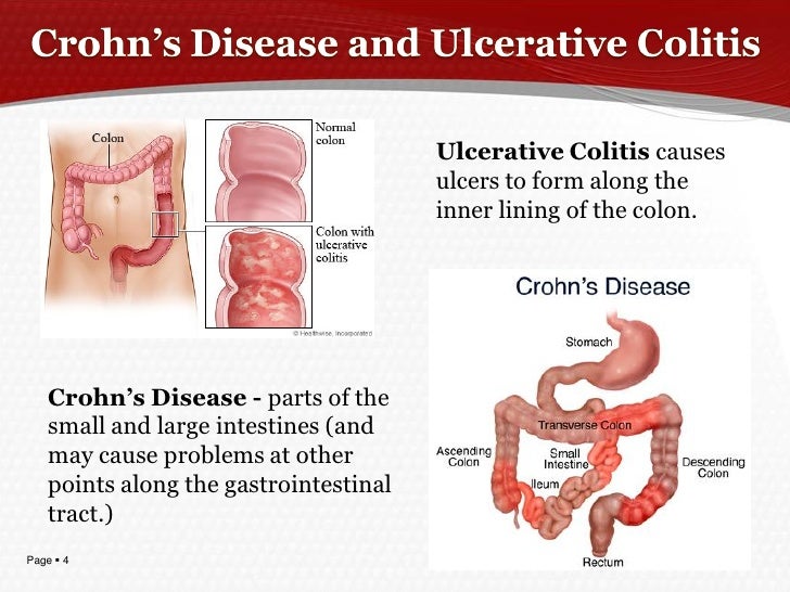 What are the causes of a bowel disease?