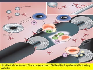 Hypothetical mechanism of immune response in Guillain-Barré syndrome Inflammatory
infiltrates
 