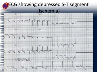 ECG showing depressed S-T segment (ischemia) 