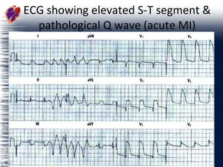 ECG showing elevated S-T segment & pathological Q wave (acute MI) 