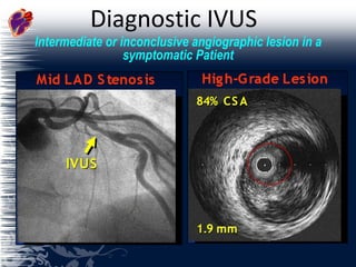 Diagnostic IVUS  Intermediate or inconclusive angiographic lesion in a symptomatic Patient 