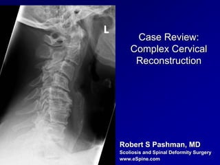 Case Review:
          Complex Cervical
           Reconstruction
78°




      Robert S Pashman, MD
      Scoliosis and Spinal Deformity Surgery
      www.eSpine.com
 