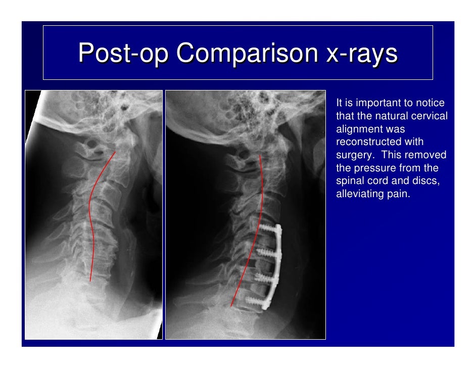 case-review-3-53-year-old-male-with-severe-spinal-cord-compression-7-728.jpg?cb=1343661811