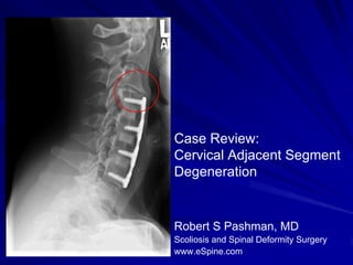 Case Review:
Cervical Adjacent Segment
Degeneration


Robert S Pashman, MD
Scoliosis and Spinal Deformity Surgery
www.eSpine.com
 