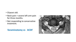 • 55years old.
• Neck pain + severe left arm pain
for three months.
• Not responding to conservative
treatment.
foraminotomy vs ACDF
 