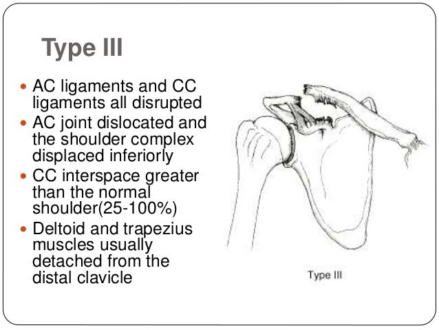 Ac dislocation