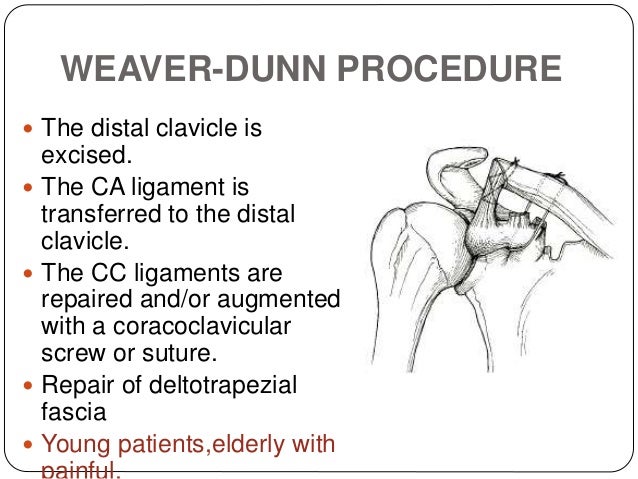 Ac dislocation