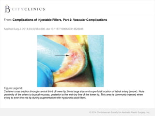© 2014 The American Society for Aesthetic Plastic Surgery, Inc.
From: Complications of Injectable Fillers, Part 2: Vascular Complications
Cadaver cross section through central third of lower lip. Note large size and superficial location of labial artery (arrow). Note
proximity of the artery to buccal mucosa, posterior to the wet-dry line of the lower lip. This area is commonly injected when
trying to evert the red lip during augmentation with hyaluronic acid fillers.
Figure Legend:
Aesthet Surg J. 2014;34(4):584-600. doi:10.1177/1090820X14525035
 