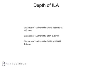 Depth of ILA
Distance of ILA from the ORAL VESTIBULE
4.7 mm
Distance of ILA from the SKIN 2.3 mm
Distance of ILA from the ORAL MUCOSA
1.5 mm
 