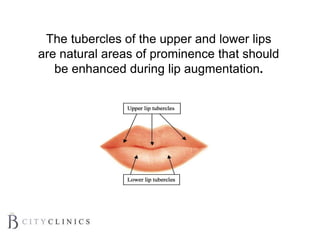 The tubercles of the upper and lower lips
are natural areas of prominence that should
be enhanced during lip augmentation.
 