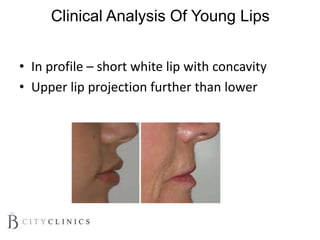 Clinical Analysis Of Young Lips
• In profile – short white lip with concavity
• Upper lip projection further than lower
 