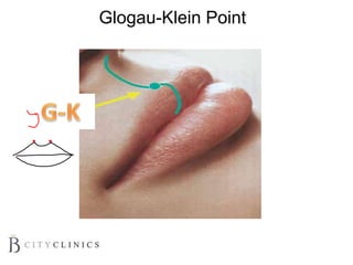 Glogau-Klein Point
 