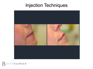 Injection Techniques
 