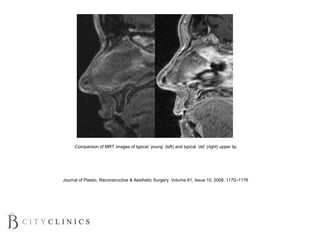 Comparison of MRT images of typical ‘young’ (left) and typical ‘old’ (right) upper lip.
Journal of Plastic, Reconstructive & Aesthetic Surgery, Volume 61, Issue 10, 2008, 1170–1176
 