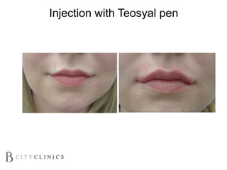 Injection with Teosyal pen
 