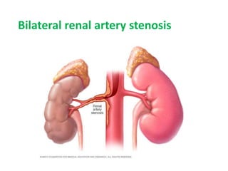 Bilateral renal artery stenosis
↓ Ang-II production
Dilatation of efferent glomerular arteriole
↓ GFR
Renal failure
 