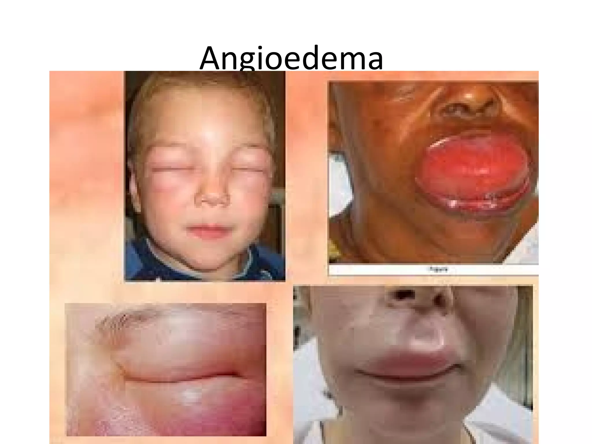 Angioedema
 