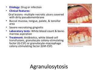 Agranulosytosis
 