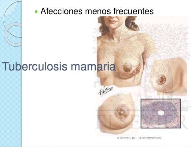 Las semillas del lino el aumento del pecho