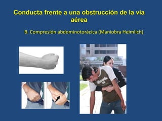 B. Compresión abdominotorácica (Maniobra Heimlich)
Conducta frente a una obstrucción de la vía
aérea
 
