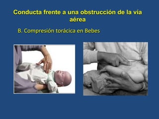B. Compresión torácica en Bebes
Conducta frente a una obstrucción de la vía
aérea
 