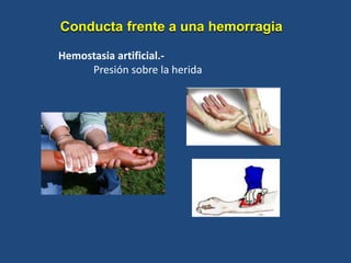 Hemostasia artificial.-
Presión sobre la herida
Conducta frente a una hemorragia
 