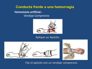 Hemostasia artificial.-
Vendaje Compresivo
Aplique un Apósito
Fije el apósito con un vendaje compresivo
Conducta frente a una hemorragia
 