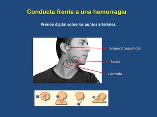 Presión digital sobre los puntos arteriales.
Temporal Superficial
Facial
Carótida
Conducta frente a una hemorragia
 