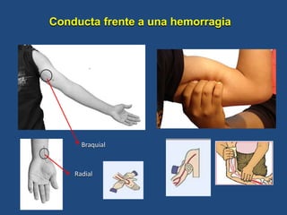 Radial
Braquial
Conducta frente a una hemorragia
 