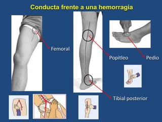 Femoral
Popitleo
Tibial posterior
Pedio
Conducta frente a una hemorragia
 
