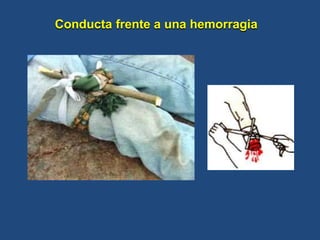 Conducta frente a una hemorragia
 