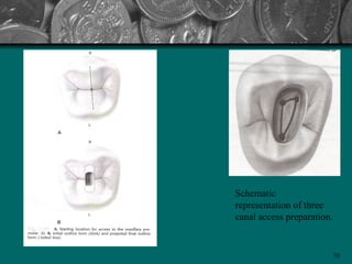 Schematic
representation of three
canal access preparation.


                        70
 