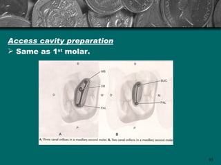 Access cavity preparation
 Same as 1st molar.




                            93
 