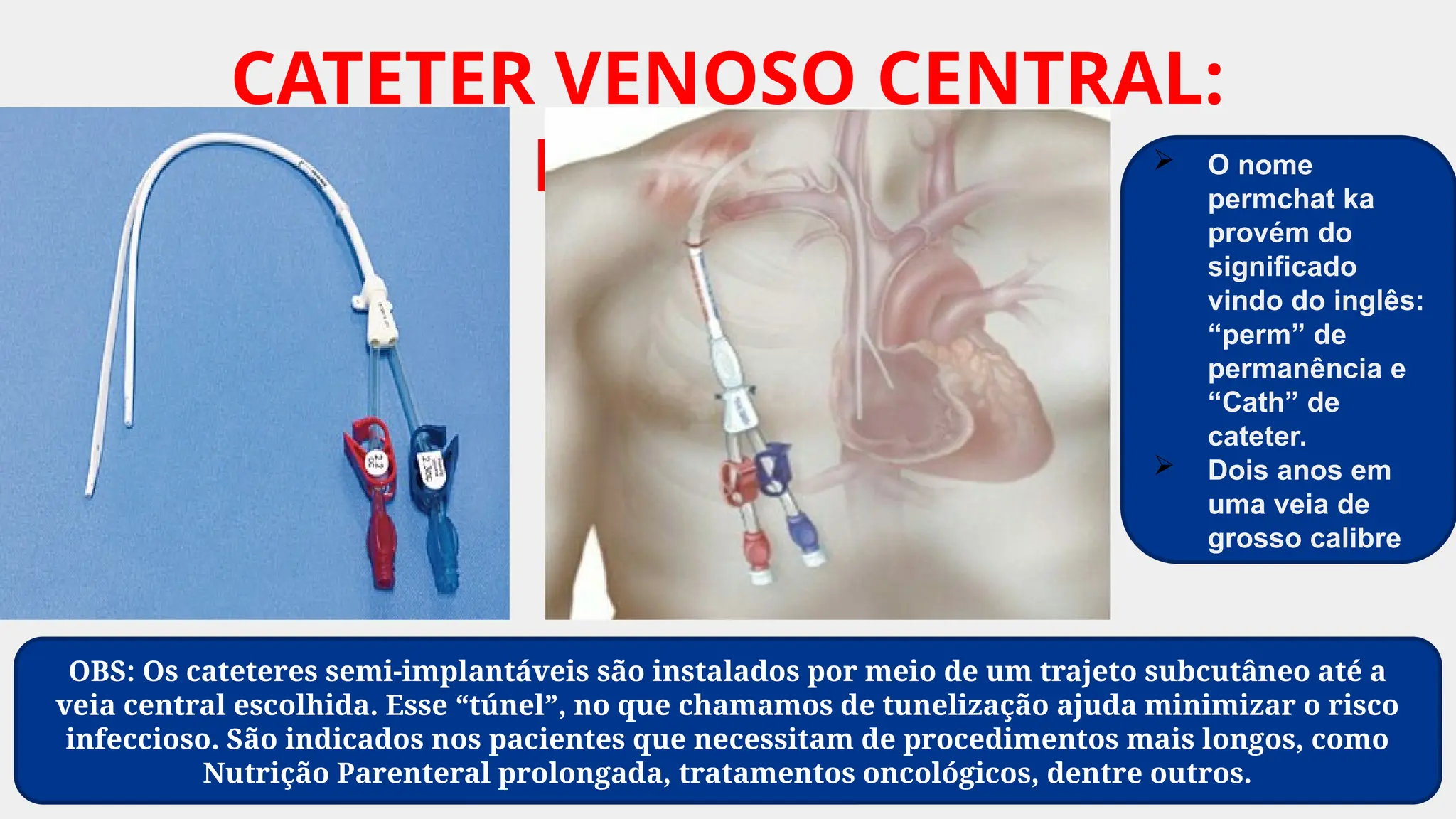 CATETER VENOSO CENTRAL:
PERMCATH  O nome
permchat ka
provém do
significado
vindo do inglês:
“perm” de
permanência e
“Cath” de
cateter.
 Dois anos em
uma veia de
grosso calibre
OBS: Os cateteres semi-implantáveis são instalados por meio de um trajeto subcutâneo até a
veia central escolhida. Esse “túnel”, no que chamamos de tunelização ajuda minimizar o risco
infeccioso. São indicados nos pacientes que necessitam de procedimentos mais longos, como
Nutrição Parenteral prolongada, tratamentos oncológicos, dentre outros.
 