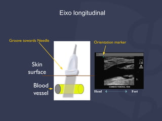 Skin
surface
Blood
vessel
Groove towards Needle Orientation marker
Head Feet
Eixo longitudinal
 