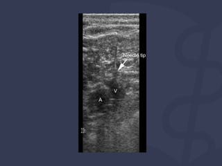  Acesso vascular POCUS