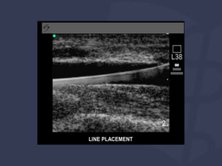  Acesso vascular POCUS