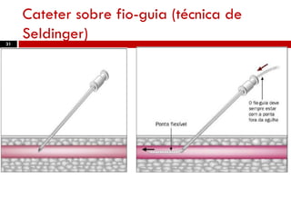 Cateter sobre fio-guia (técnica de
Seldinger)31
 