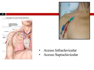 Subclávia
43
• Acesso Infraclavicular
• Acesso Supraclavicular
 