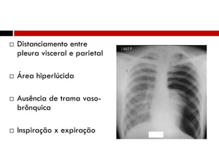 Interpretação radiológica
 Distanciamento entre
pleura visceral e parietal
 Área hiperlúcida
 Ausência de trama vaso-
brônquica
 Inspiração x expiração
60
 