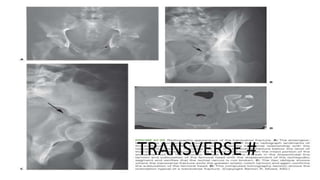.
TRANSVERSE #
 