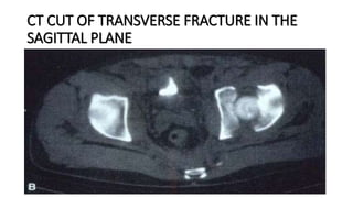 CT CUT OF TRANSVERSE FRACTURE IN THE
SAGITTAL PLANE
 
