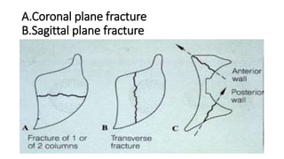 A.Coronal plane fracture
B.Sagittal plane fracture
 