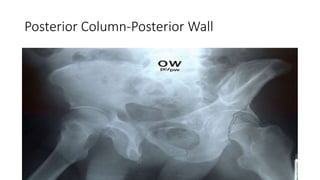 Posterior Column-Posterior Wall
 