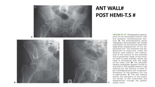 ANT WALL#
POST HEMI-T.S #
 