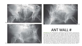 .
ANT WALL #
 