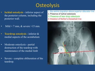 Osteolysis
• Ischial osteolysis - inferior aspect of
the posterior column, including the
posterior wall.
• Mild < 7 mm, & severe >15 mm.
• Teardrop osteolysis - inferior &
medial aspects of the acetabulum
• Moderate osteolysis - partial
destruction of the teardrop with
maintenance of the medial limb
• Severe - complete obliteration of the
teardrop.
 