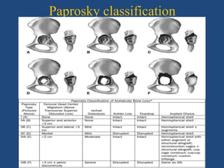 Paprosky classification
 