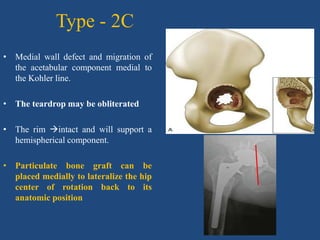 Type - 2C
• Medial wall defect and migration of
the acetabular component medial to
the Kohler line.
• The teardrop may be obliterated
• The rim intact and will support a
hemispherical component.
• Particulate bone graft can be
placed medially to lateralize the hip
center of rotation back to its
anatomic position
 