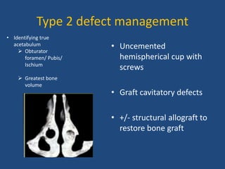 Type 2 defect management
• Uncemented
hemispherical cup with
screws
• Graft cavitatory defects
• +/- structural allograft to
restore bone graft
• Identifying true
acetabulum
 Obturator
foramen/ Pubis/
Ischium
 Greatest bone
volume
 